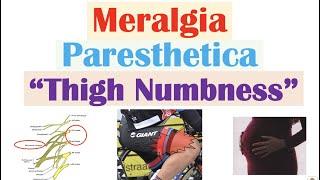 Meralgia Paresthetica (“Numbness of the Thigh”) | Causes, Symptoms, Diagnosis, Treatment