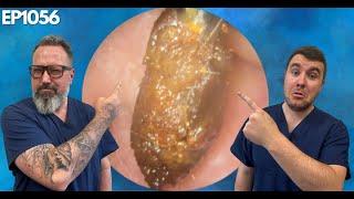 MESSY KERATOSIS OBTURANS - HUGE EAR WAX & SKIN PLUG REMOVAL - EP1056