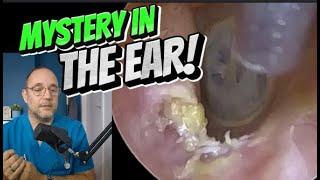 MYSTERY IN THE EAR! 366 #ear #earwax #earwaxremoval #satisfying #foryou #fyp #foryourpage