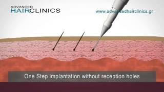 One Step Hair Implantation method #advancedhairclinics