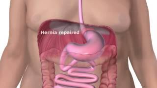 Hiatal Hernia and Fundoplication