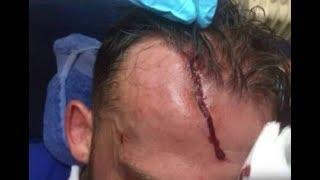 Luke Fletcher head injury | blood warks vs not