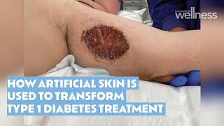 How artificial skin is used to transform Type 1 diabetes treatment