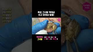 족보그녀들 역대급 최고 문제성발톱 관리하기!! #레푸스 #refuss #무좀발톱 #발톱 #toenails #내성발톱 #발톱무좀 #ingrown_toenail_surgery