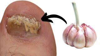 How GARLIC Remove FUNGAL FOOT INFECTION?