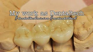 My work as Dental Technician | removable & permanent prosthetic