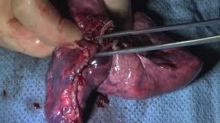 VATS Right Upper Lobectomy | Brigham and Women's Hospital