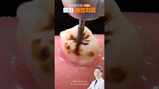 치과 레진치료 #shrots