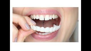 Snap On Smile - Элайнеры, Veneer, Установка, Отзывы, Цена, Стоимость, Виниры На Зубы