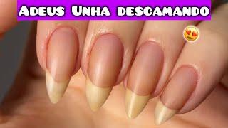 UNHAS DESCAMANDO: O QUE FAZER? SOLUÇÕES COMPLETAS