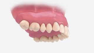 Atlantis Conus concept animation | Dentsply Sirona