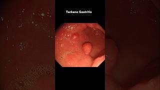 Ini yang terjadi pada lambung saat kita makan makanan pedas #gastritis #asamlambung #makananpedas
