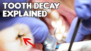 Tooth Decay (Cavity) Explained | Cavities vs Fillings vs Dental Caries