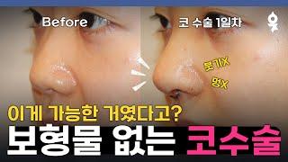 실리콘 코수술 후 바로 일상생활 가능! 하루 만에 예뻐지는 코수술 비결