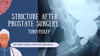 Urethroplasty for Post TURP / Post Holep Strictures of uretrhra