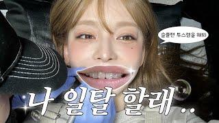 tooth gem vlog  투스젬 나도 해봤다 ( 내 후기는 .. )