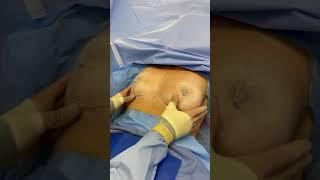 IMMEDIATELY AFTER SURGERY | BREAST LIFT