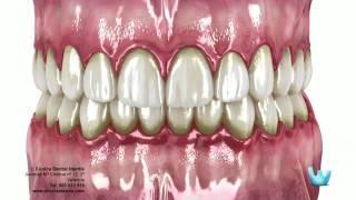 La enfermedad periodontal: Gingivitis y Periodontitis