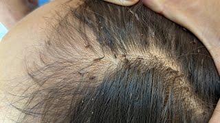 Remove many lice from brown hair - Plucking most of lice from head