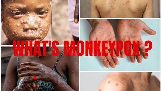 Monkeypox 2025 |  New Symptoms, Prevention & What You Need to Know