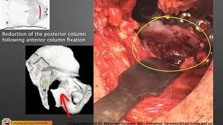 The Modified Stoppa Approach in the Treatment of a T-shaped Acetabular Fracture