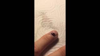 How To Remove Blood From Under Fingernail! Red Hot Safety Pin! Relief!