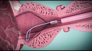 I-TIND procedure 3D animation by Medi-Tate