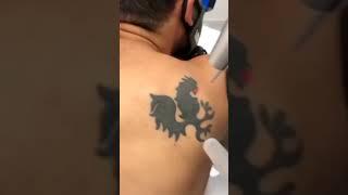 Laser tattoo Removal || How to remove tattoo