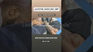 TORONTO SMP | SCALP MICROPIGMENTATION (905)767-9101 BEST RESULTS IN CANADA.