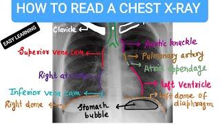 How To Read A Chest X-ray