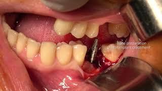 Single implant placement for missing lower molar. Surgery by Dr. Viktor Kalenchuk