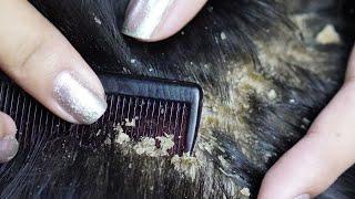 Dandruff scratching removal on head using black combing#337