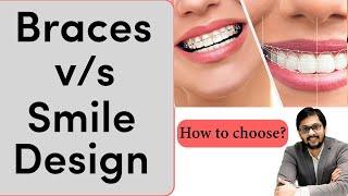 Braces vs Smile Design how to choose? | क्या चुने दोनों मे से? | Seraphic dental Indore