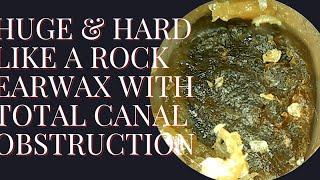 HUGE & HARD Like A Rock Earwax With Total Ear Canal Obstruction