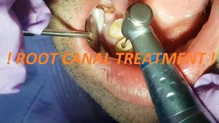 ROOT CANAL TREATMENT !!!