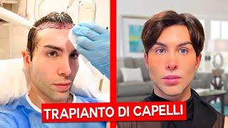 TRAPIANTO DI CAPELLI: LA MIA ESPERIENZA | GIANMARCO ZAGATO