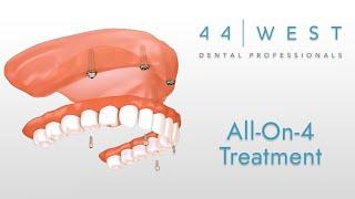 All-On-4 Implants | Grandville Dentist | 44 West Dental Professionals