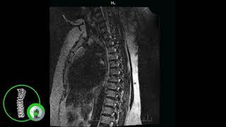 МРТ грудного отдела позвоночника видео (что видно на снимках)