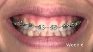 Emily's 10 weeks in braces