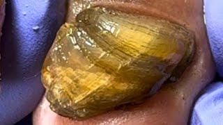 Thick Black Mud Piled Up On The Nails, Forming A Rockery【Dr. Liu's Pedicur】