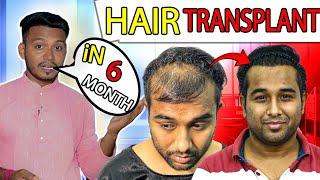 Diffuse Hair Transplant Result ll Only 4k Grafts TOTAL