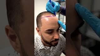 Hair Transplant in Care4Hair , Miami , Florida