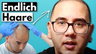 2 Wochen nach der Haartransplantation in Deutschland | Erfahrungsbericht