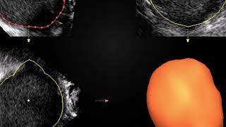 Endometrioza