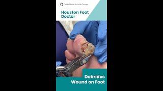 Wound Debridement by Houston Foot Doctor #woundcare #podiatrist #footdoctor