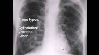 chest x-ray, bronchiectasis