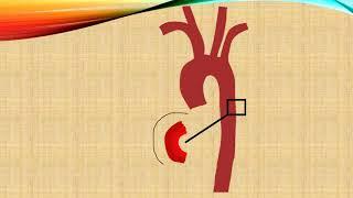 Aortenaneurysma