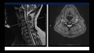 C5 Palsy After C4-C7 ACDF