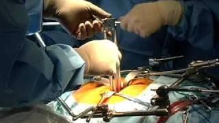 Synthes Spine ProDisc-L Lumbar Total Disc Replacement Surgical Video