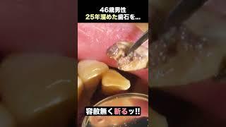 【仁義なき歯石除去】25年溜めた歯石を成敗します #歯医者 #ザホワイトデンタルクリニック #歯石除去